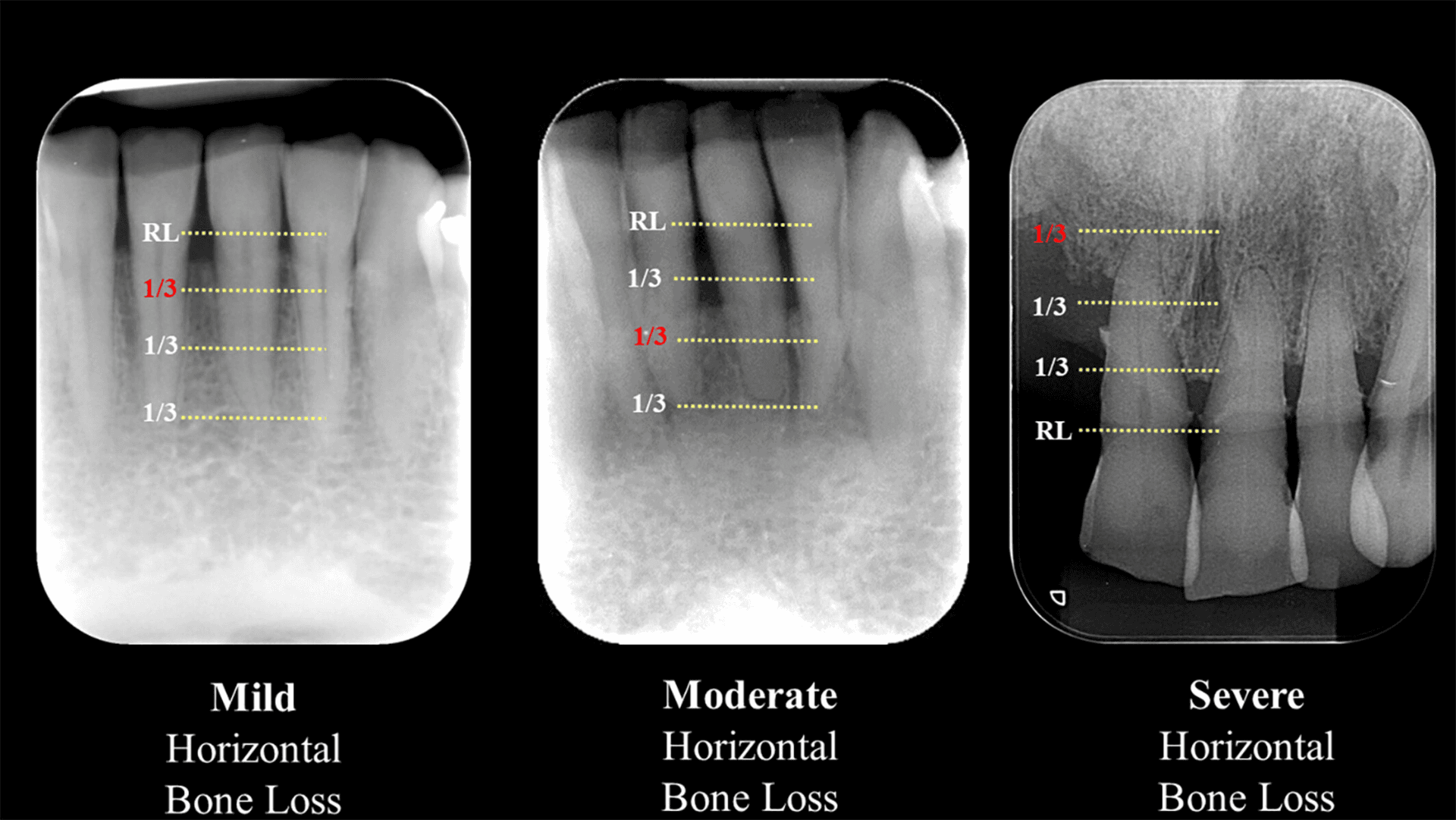 Figure 1. Severity of horizontal bone loss (mild, moderate, severe) on periapical radiographs