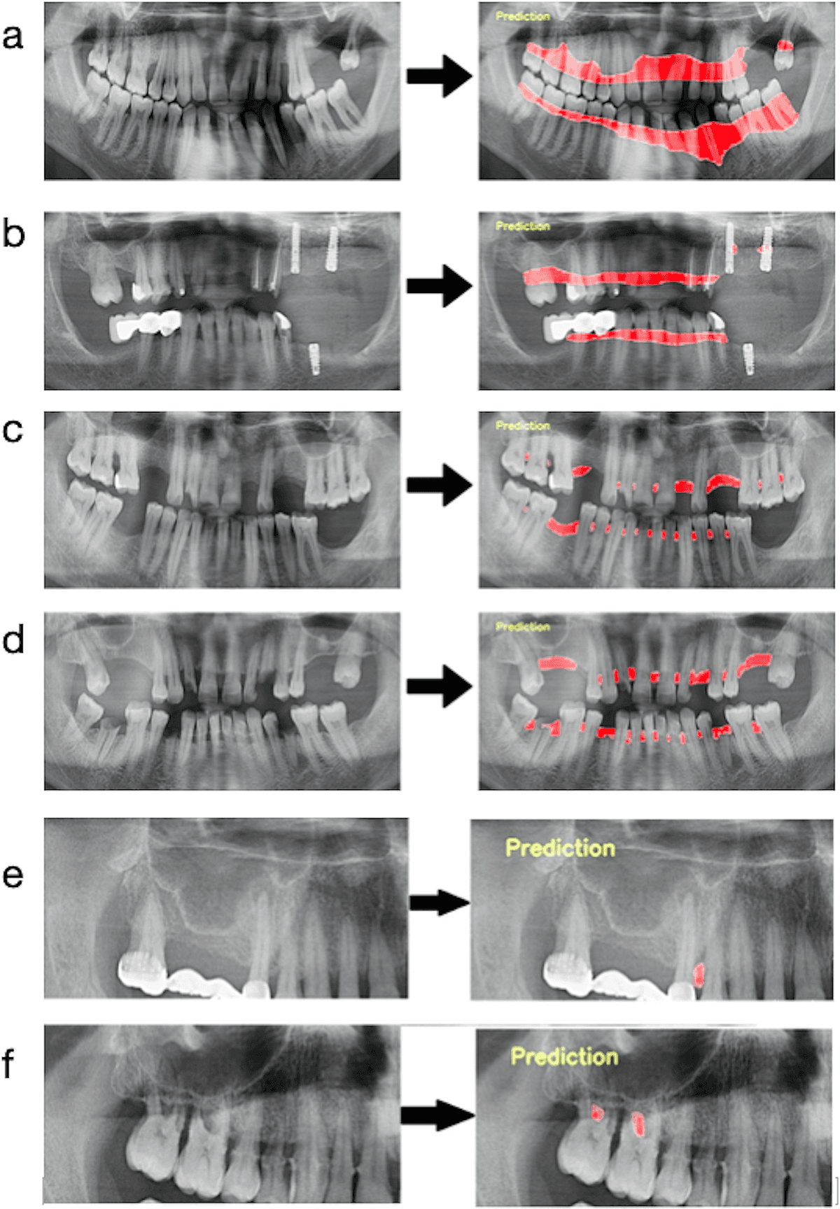 Figure 2. AI detection of periodontal bone loss on panoramic radiographs