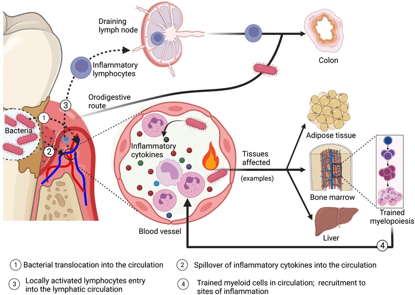 Figure 3. The Oral–Systemic Pathway Linking Periodontitis to Cardiovascular Disease