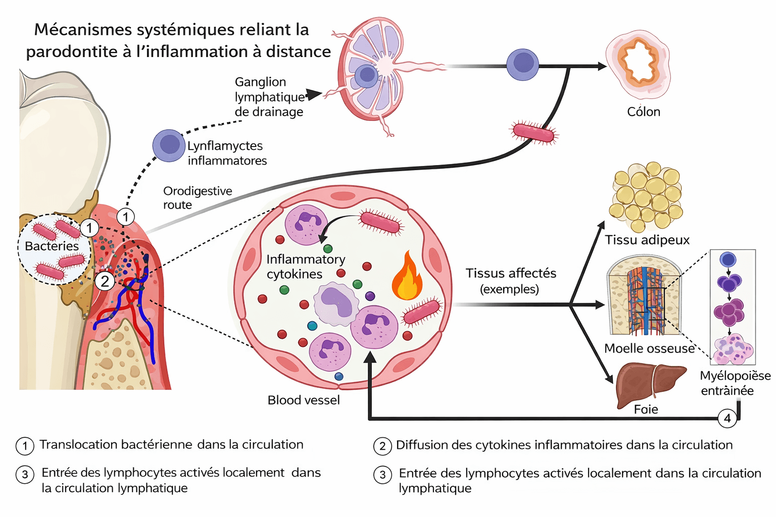 Figure 3. La voie orale–systémique reliant la parodontite aux maladies cardiovasculaires
